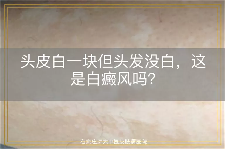 头皮白一块但头发没白，这是白癜风吗？