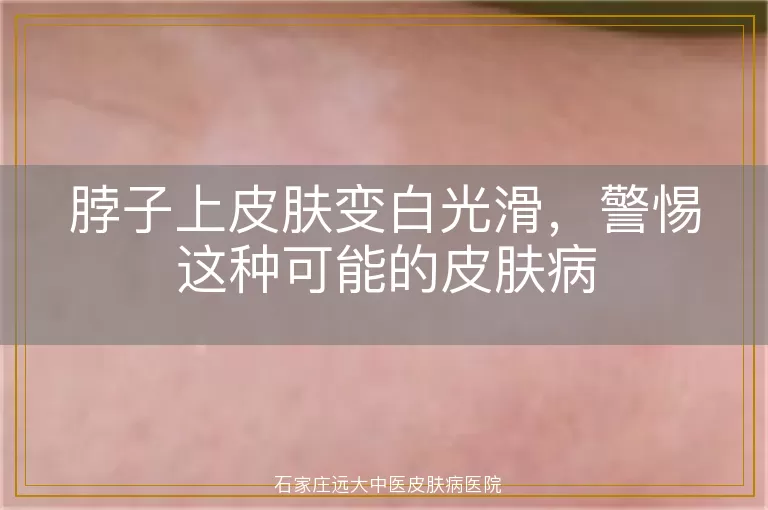 脖子上皮肤变白光滑，警惕这种可能的皮肤病