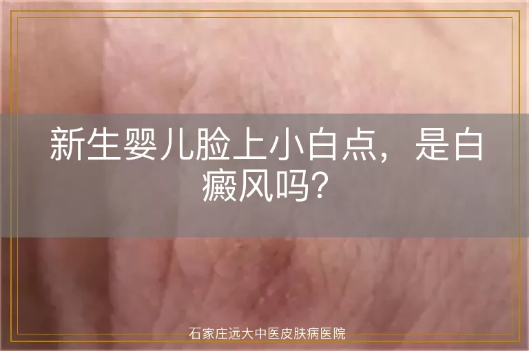 新生婴儿脸上小白点，是白癜风吗？