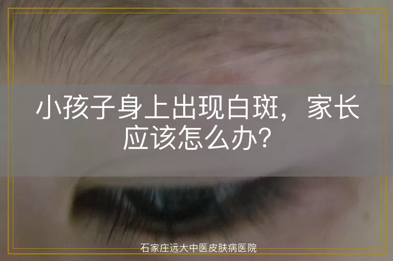 小孩子身上出现白斑，家长应该怎么办？