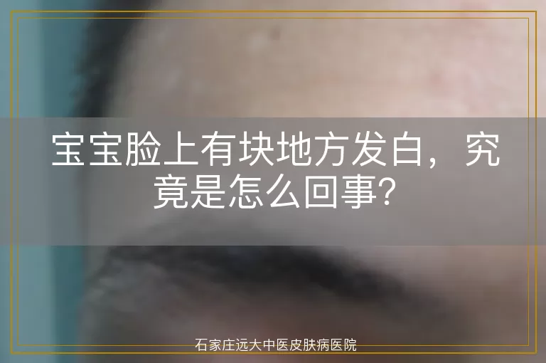宝宝脸上有块地方发白，究竟是怎么回事？