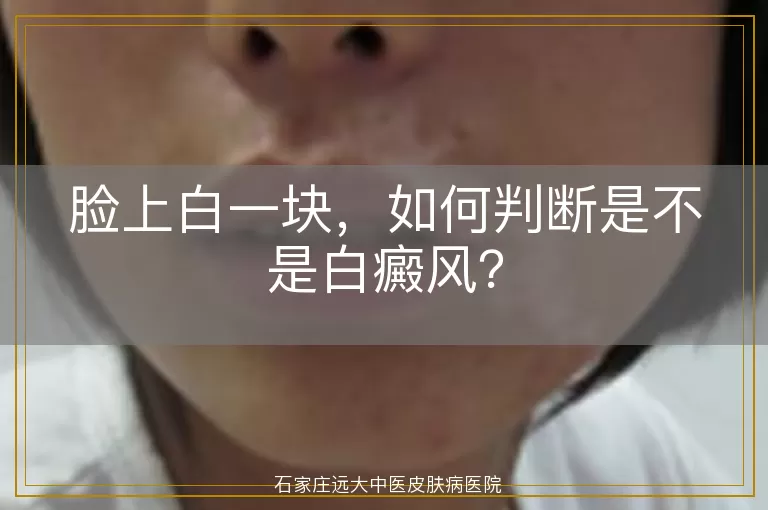 脸上白一块，如何判断是不是白癜风？