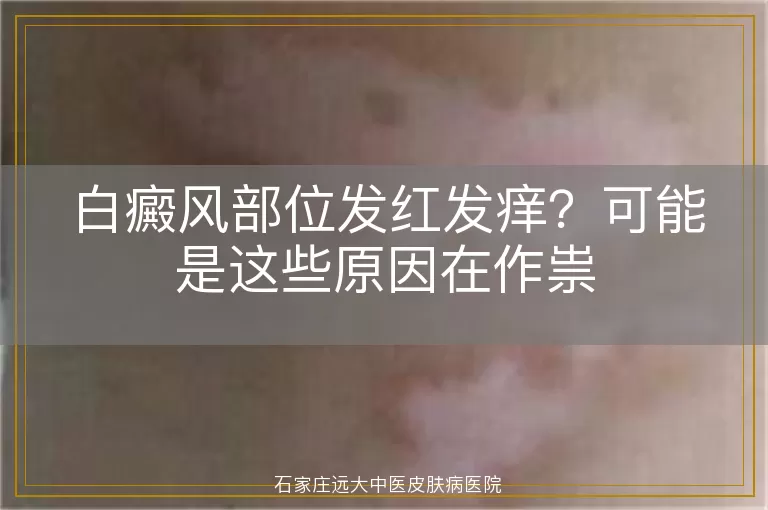 白癜风部位发红发痒？可能是这些原因在作祟