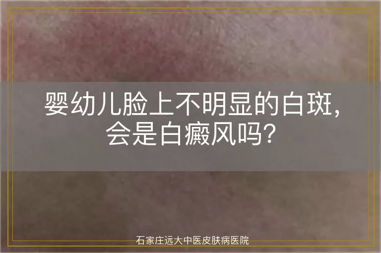 婴幼儿脸上不明显的白斑，会是白癜风吗？