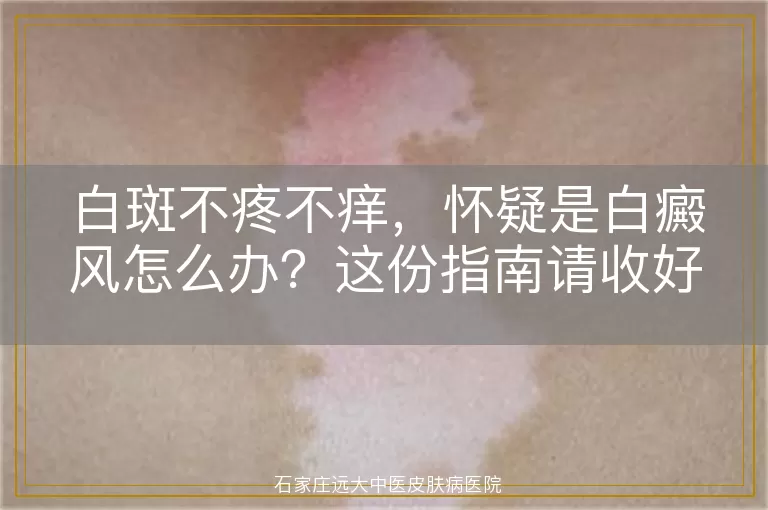 白斑不疼不痒，怀疑是白癜风怎么办？这份指南请收好！