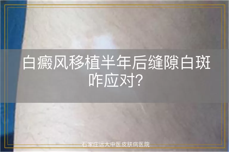 白癜风移植半年后缝隙白斑咋应对？