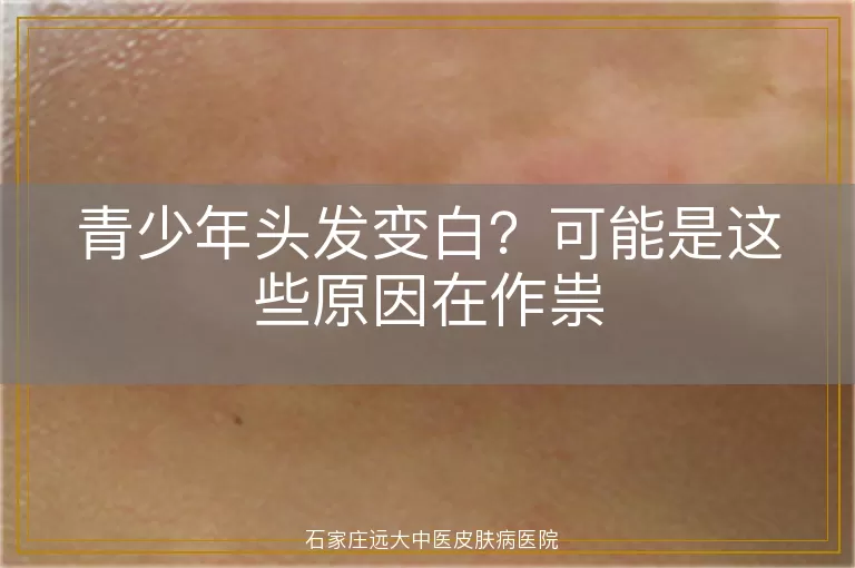 青少年头发变白？可能是这些原因在作祟