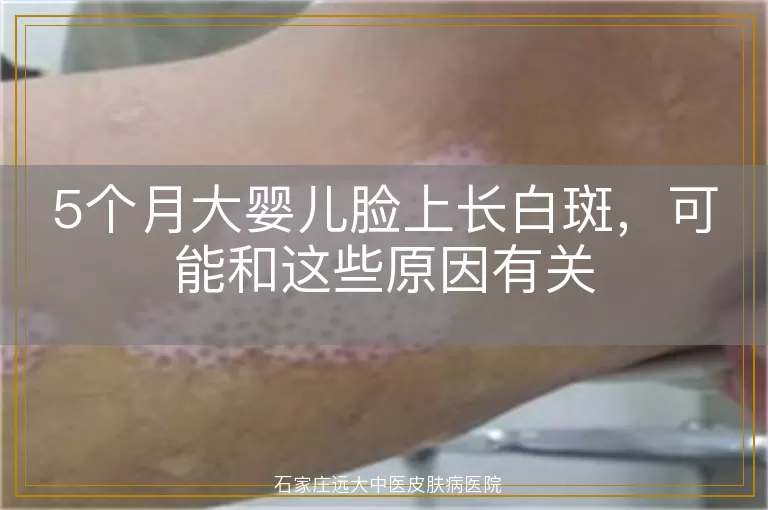 5个月大婴儿脸上长白斑，可能和这些原因有关