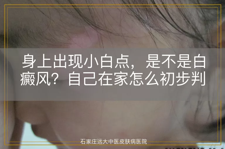 身上出现小白点，是不是白癜风？自己在家怎么初步判断？
