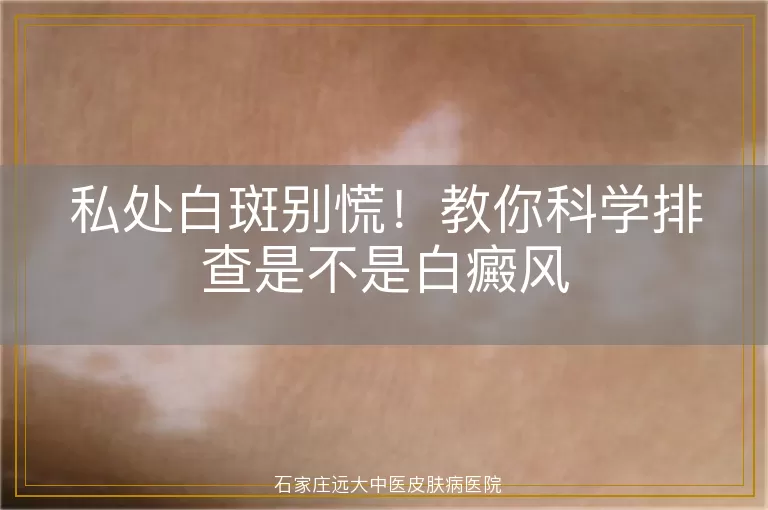 私处白斑别慌！教你科学排查是不是白癜风