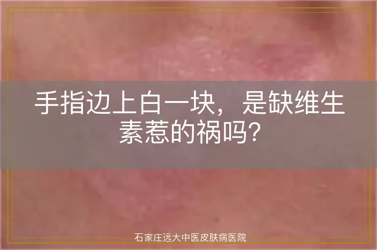 手指边上白一块，是缺维生素惹的祸吗？