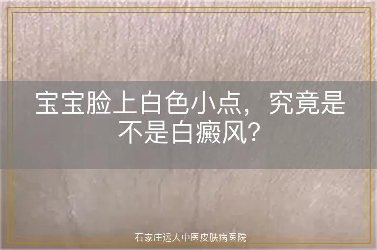 宝宝脸上白色小点，究竟是不是白癜风？