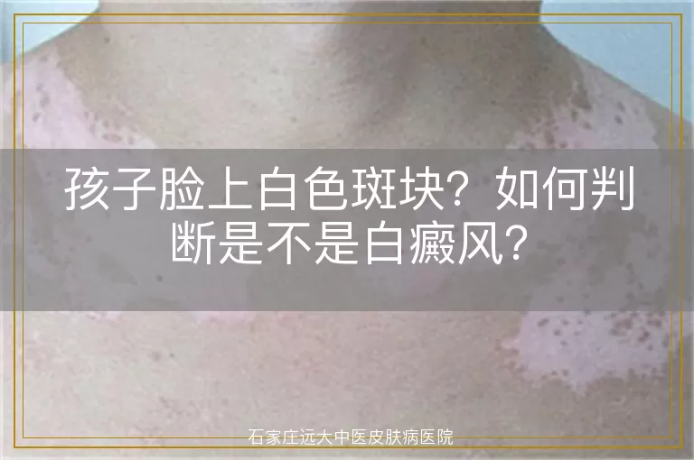 孩子脸上白色斑块？如何判断是不是白癜风？