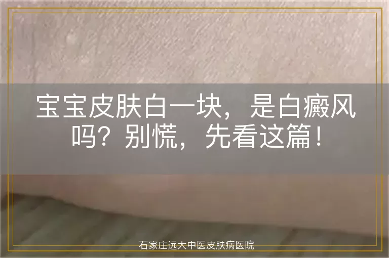 宝宝皮肤白一块，是白癜风吗？别慌，先看这篇！