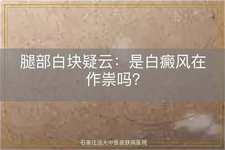 腿部白块疑云：是白癜风在作祟吗？