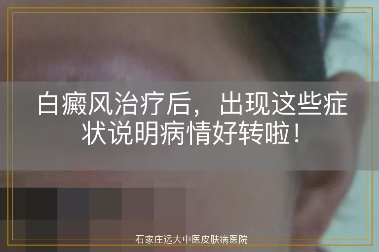 白癜风治疗后，出现这些症状说明病情好转啦！