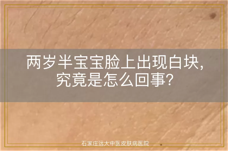两岁半宝宝脸上出现白块，究竟是怎么回事？