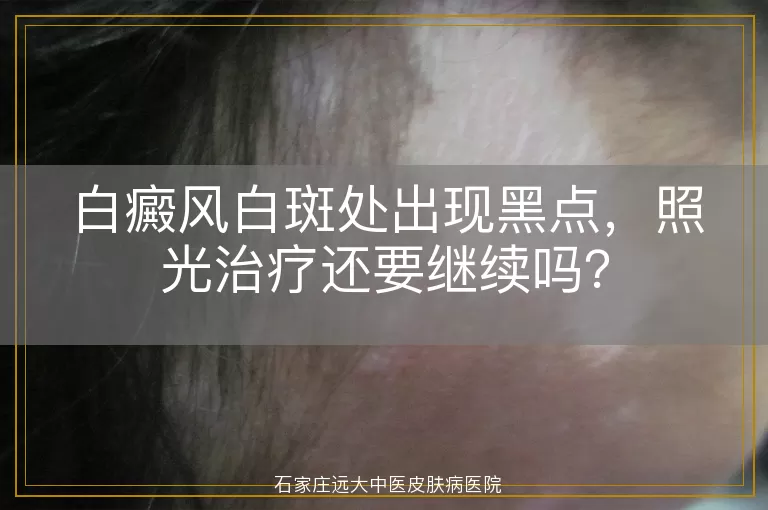 白癜风白斑处出现黑点，照光治疗还要继续吗？