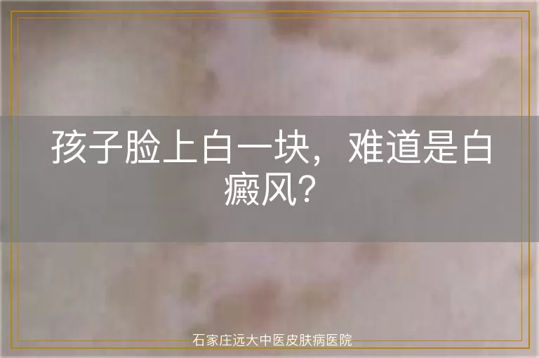孩子脸上白一块，难道是白癜风？