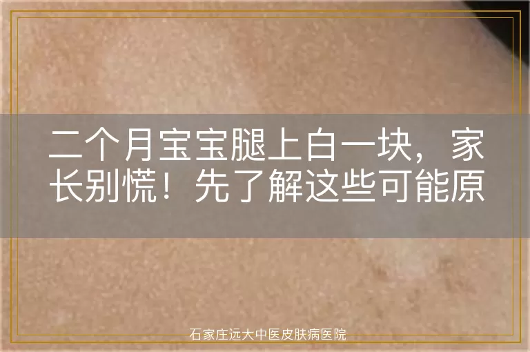 二个月宝宝腿上白一块，家长别慌！先了解这些可能原因