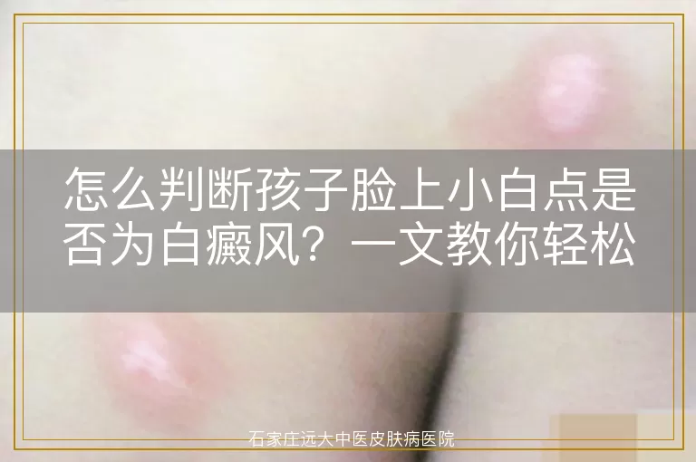 怎么判断孩子脸上小白点是否为白癜风？一文教你轻松识别