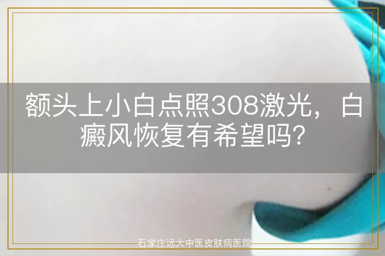 额头上小白点照308激光，白癜风恢复有希望吗？