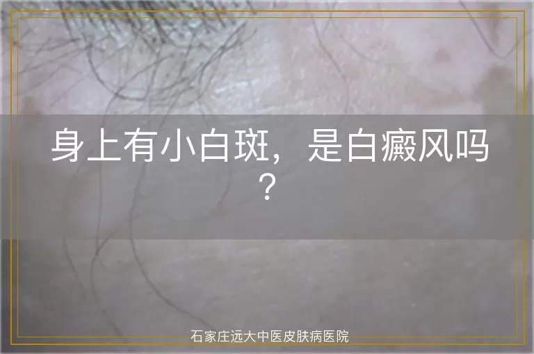 身上有小白斑，是白癜风吗？