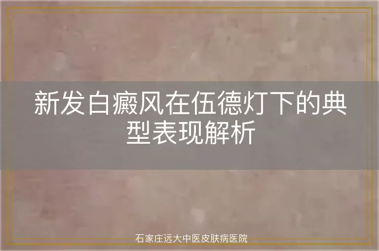 新发白癜风在伍德灯下的典型表现解析