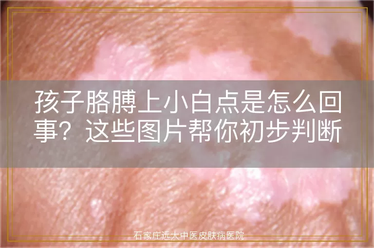 孩子胳膊上小白点是怎么回事？这些图片帮你初步判断