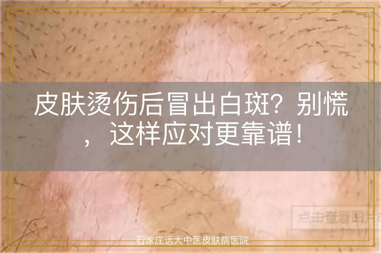 皮肤烫伤后冒出白斑？别慌，这样应对更靠谱！