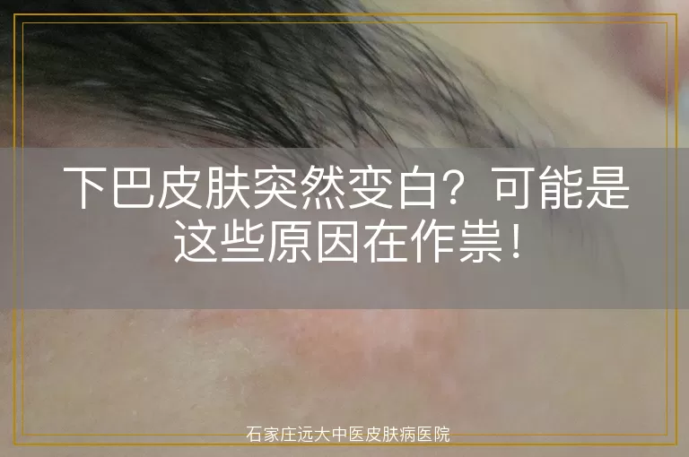 下巴皮肤突然变白？可能是这些原因在作祟！