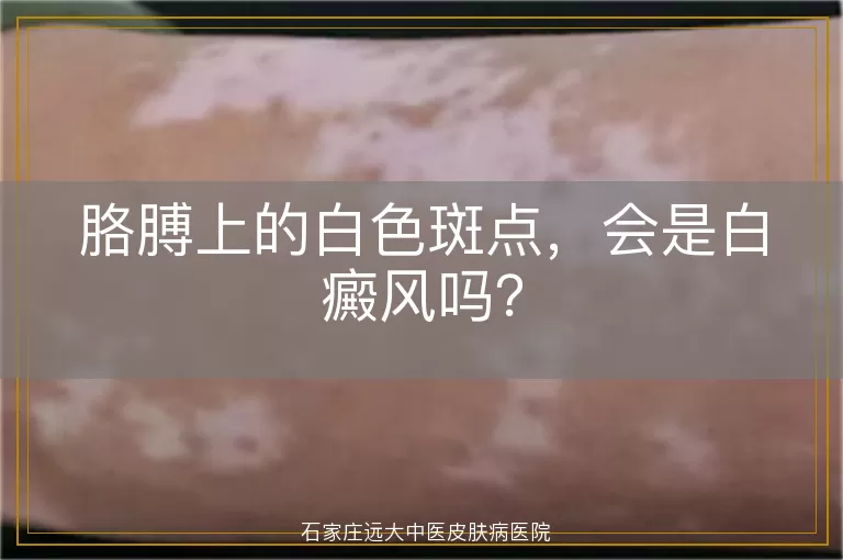 胳膊上的白色斑点，会是白癜风吗？