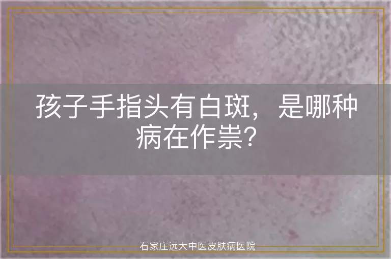 孩子手指头有白斑，是哪种病在作祟？