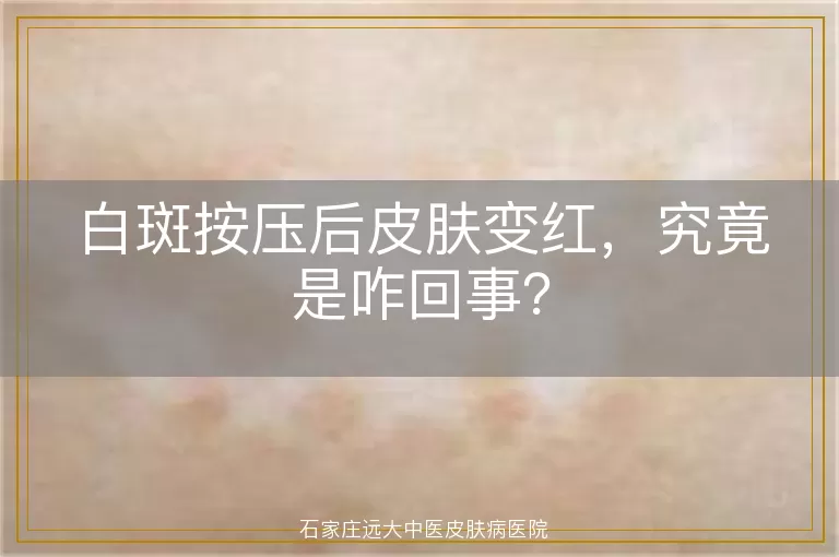 白斑按压后皮肤变红，究竟是咋回事？