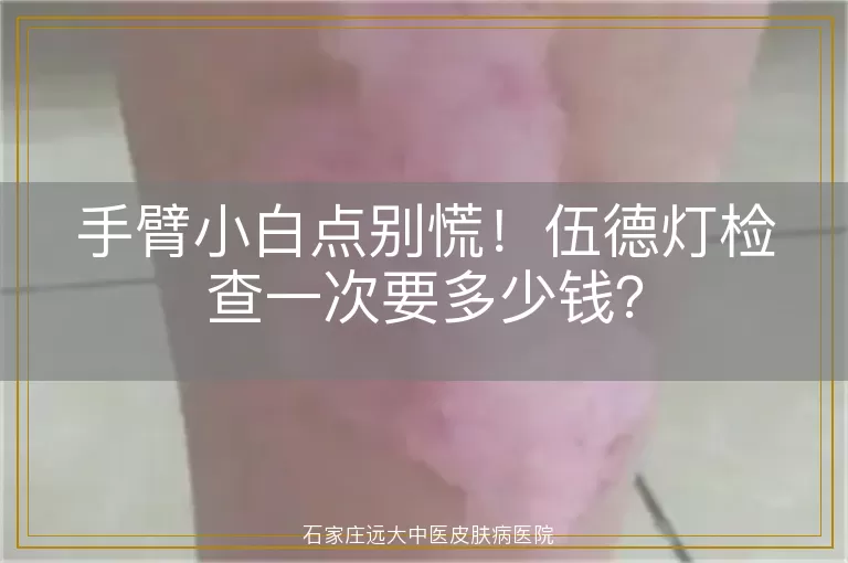 手臂小白点别慌！伍德灯检查一次要多少钱？
