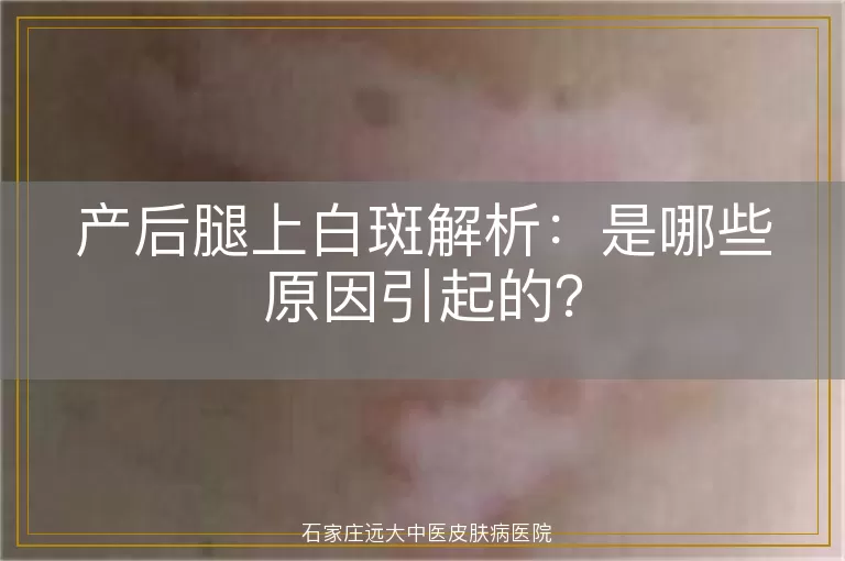 产后腿上白斑解析:是哪些原因引起的?