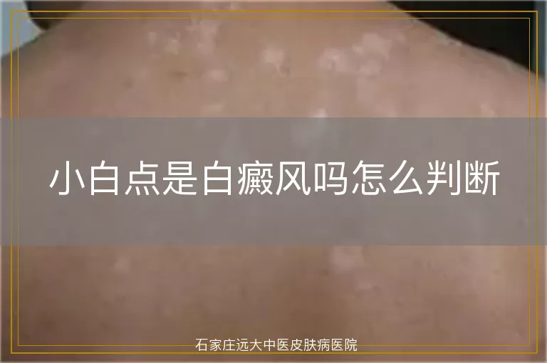 小白点是白癜风吗怎么判断