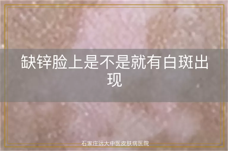 缺锌脸上是不是就有白斑出现