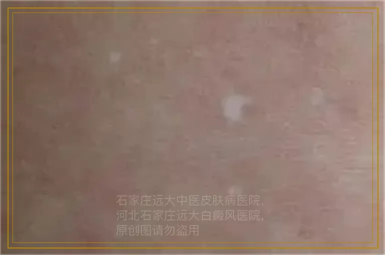 胳膊上面有小白点怎么办是什么病
