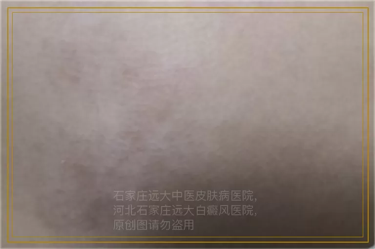 白斑是不是白癜风 怎么区分