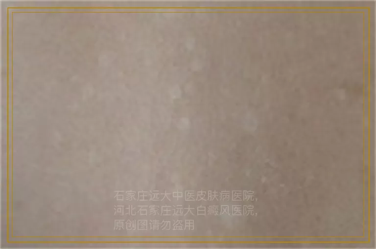 孩子腿上白一块一块的还痒该怎么办