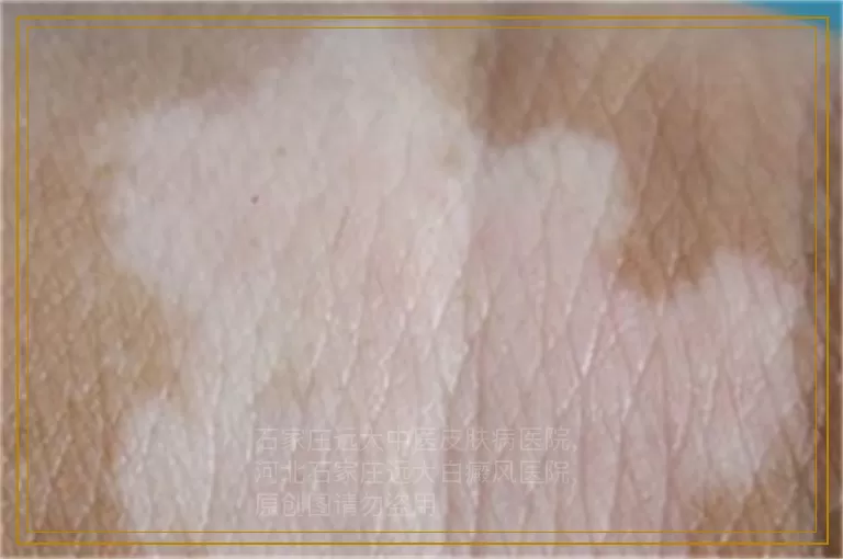 脸上有几个小白点是得了什么病