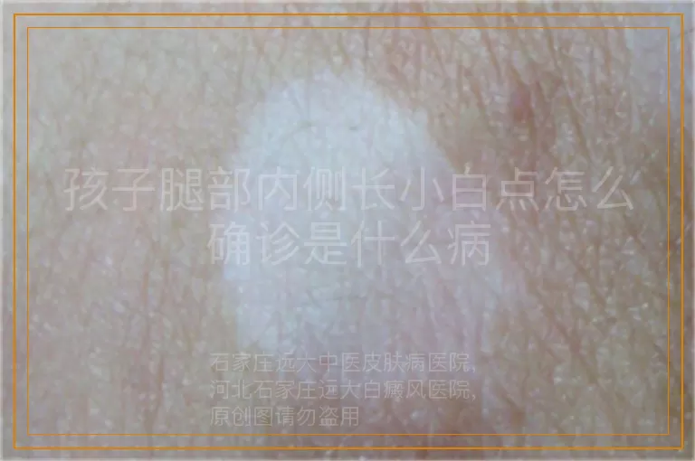 孩子腿部内侧长小白点怎么确诊是什么病