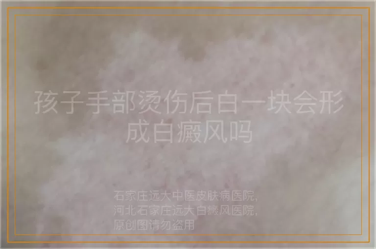 孩子手部烫伤后白一块会形成白癜风吗
