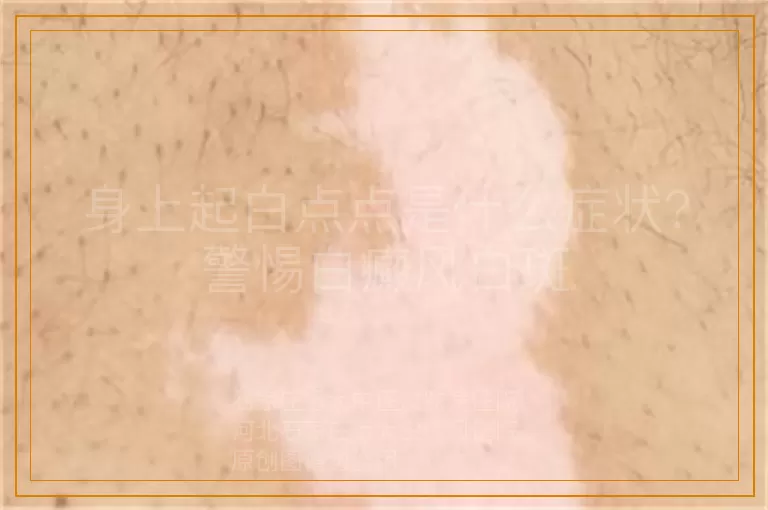 身上起白点点是什么症状？警惕白癜风白斑
