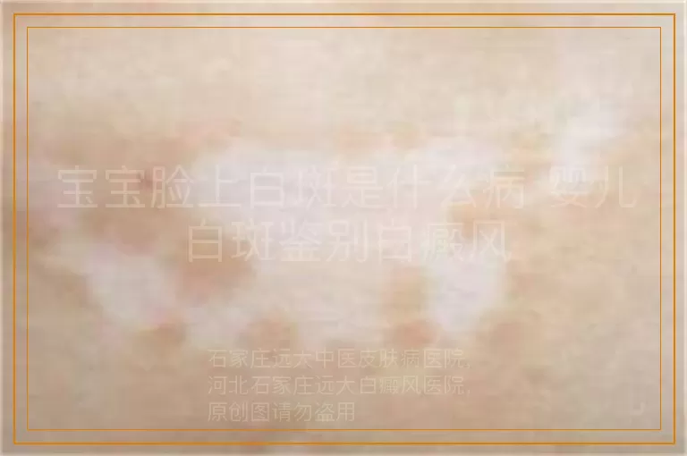 宝宝脸上白斑是什么病 婴儿白斑鉴别白癜风