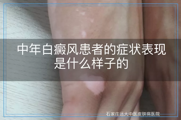 中年白癜风患者的症状表现是什么样子的