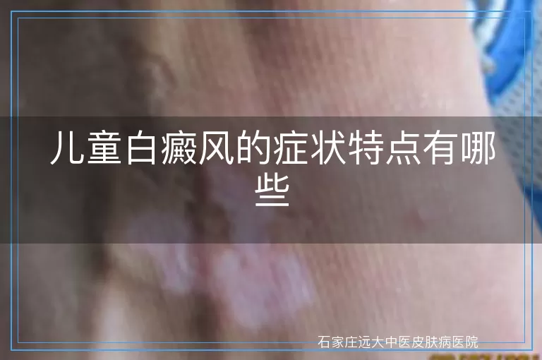 儿童白癜风的症状特点有哪些