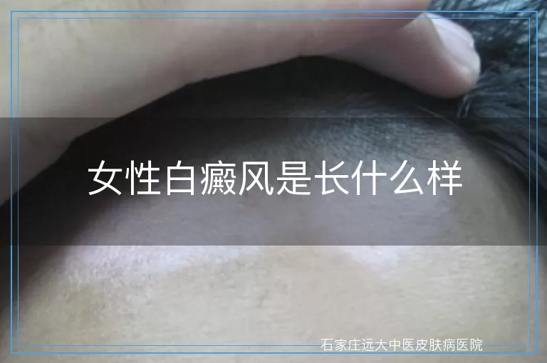 女性白癜风是长什么样