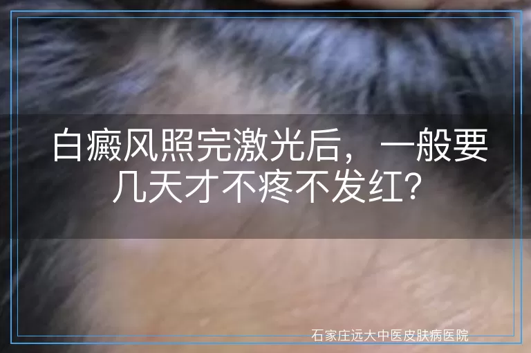 白癜风照完激光后，一般要几天才不疼不发红？